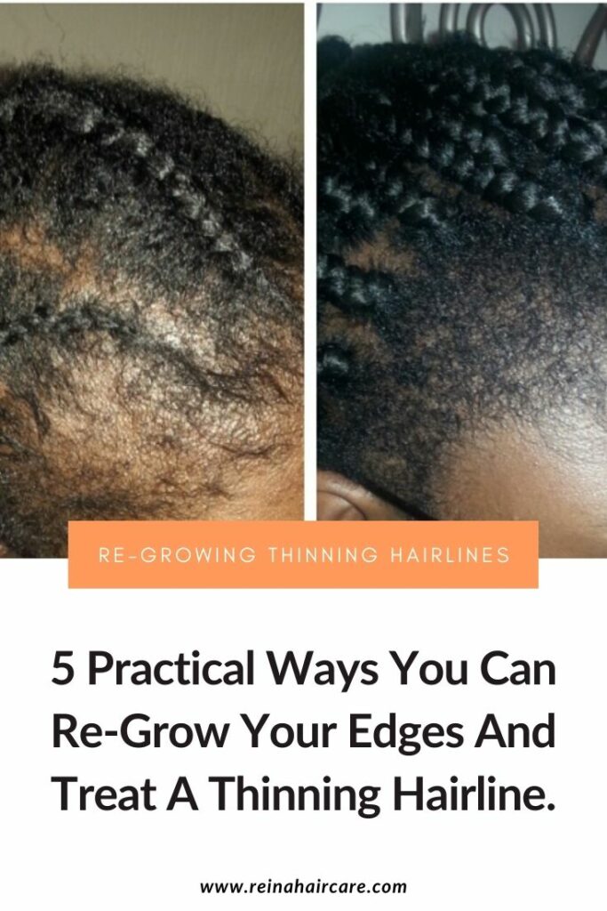 How To Regrow Baby Hairs After Hair Thinning?