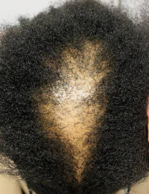 Everything you need to know about alopecia or circular hair loss - Gaia  Naturelle