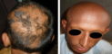 Different Types Of Alopecia And How To Treat Or Cure Them - Reina Haircare