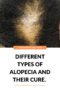 Different Types Of Alopecia And How To Treat Or Cure Them - Reina Haircare