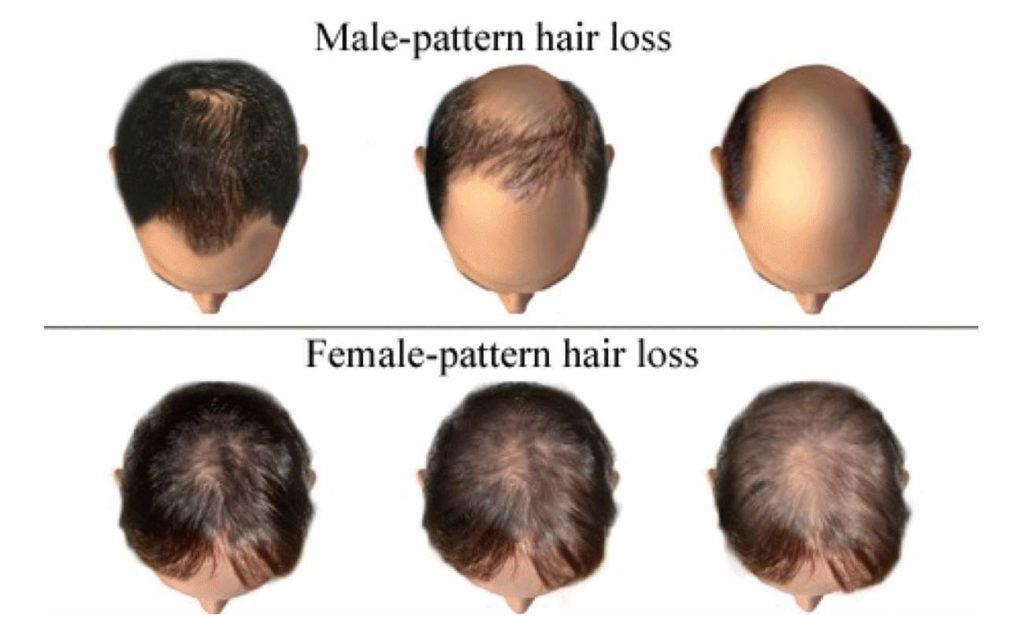 Male Androgenetic Alopecia - Endotext - NCBI Bookshelf